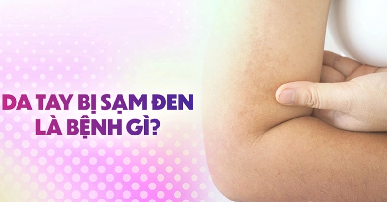 Giải đáp bí ẩn da tay bị thâm đen là bệnh gì theo góc nhìn y khoa