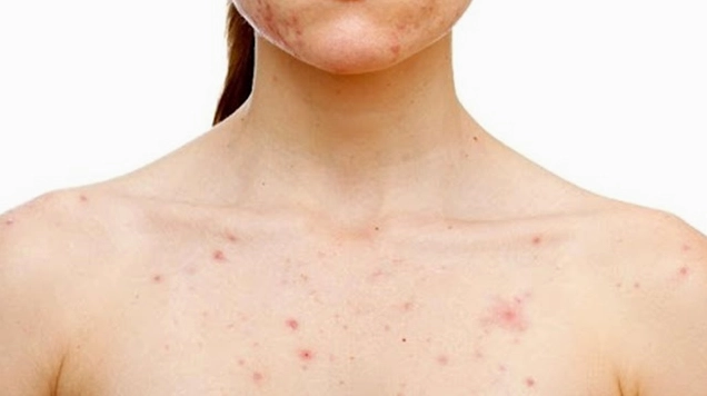 Giải đáp mọc mụn ở ngực la bệnh gì và cách xử lý khoa học