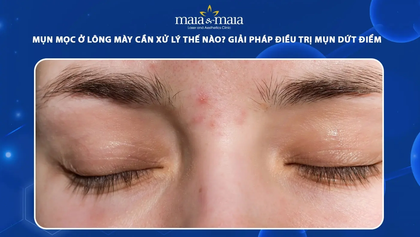 Giải đáp mụn mọc ở chân mày là bệnh gì và cách xử lý hiệu quả