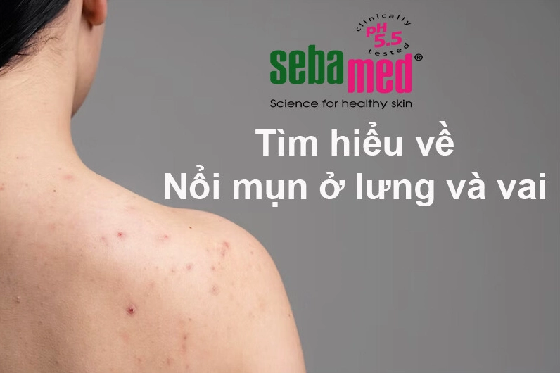 Giải đáp mụn mọc ở vai là bệnh gì và cách xử lý khoa học