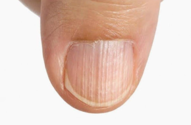 Giải đáp ngón tay bị sọc đen là bệnh gì và dấu hiệu cần cảnh giác