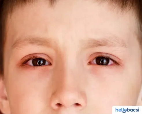 Giải đáp nguyên nhân của bệnh đau mắt đỏ là gì theo chuyên gia y tế
