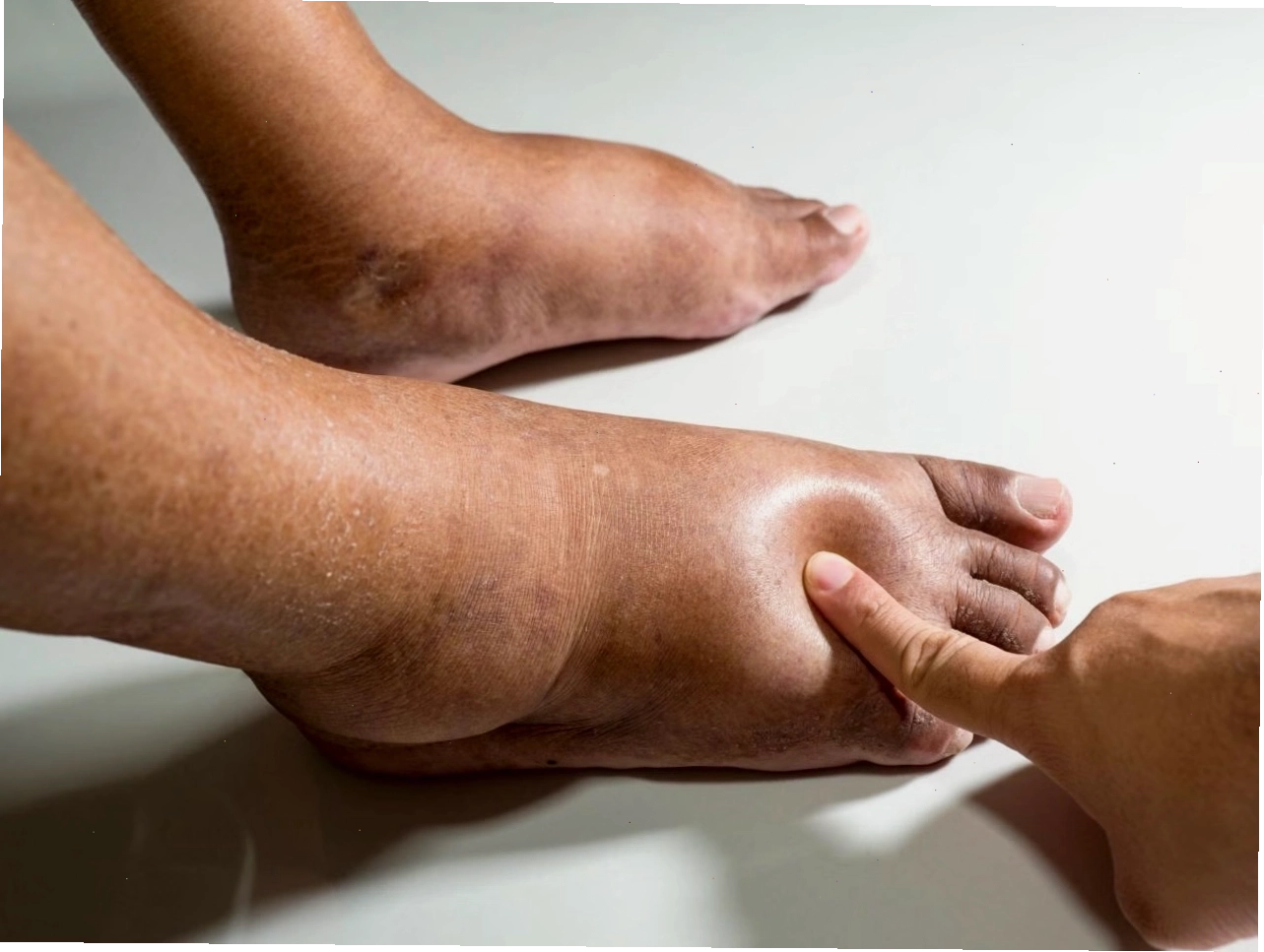 Giải đáp phù chân có nguy hiểm không