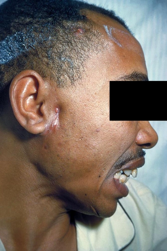 Giải đáp thắc mắc actinomyces gây bệnh gì và cách nhận diện bệnh hiệu quả