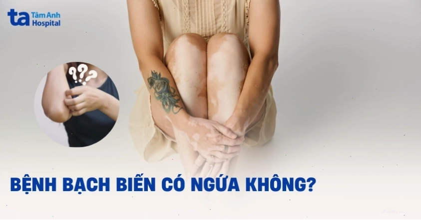 Giải đáp thắc mắc bệnh bạch biến có gây ngứa không