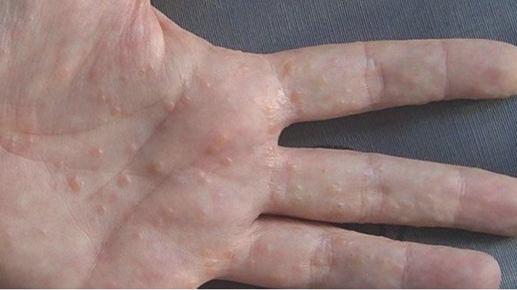 Giải đáp thắc mắc bệnh tổ đỉa có lây không