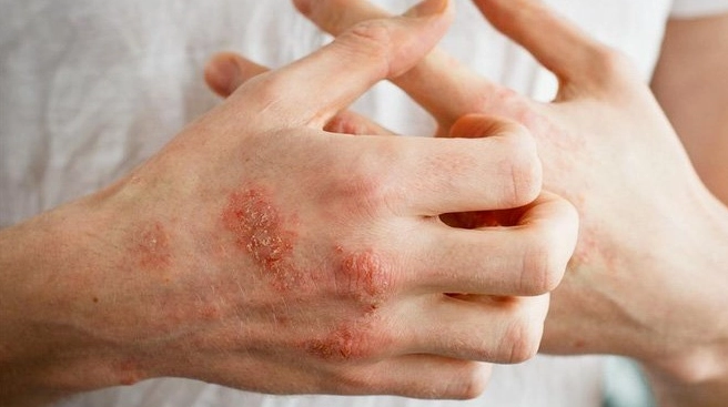 Giải đáp thắc mắc bị chàm tay la bệnh gì và cách kiểm soát hiệu quả