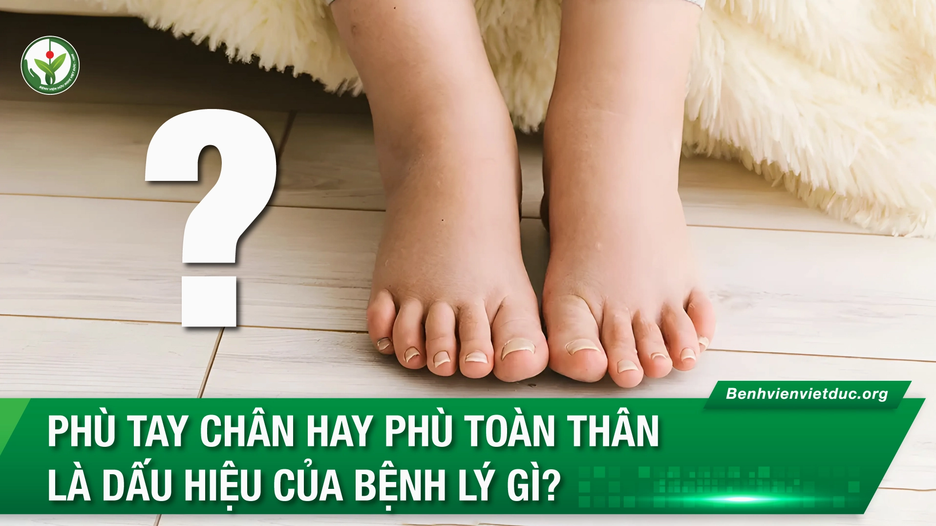 Giải đáp thắc mắc bị phù toàn thân là bệnh gì và các dấu hiệu cảnh báo