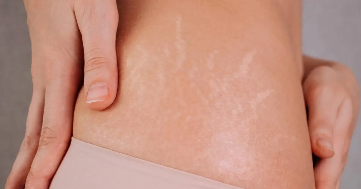 Giải đáp thắc mắc bị rạn da là bệnh gì và các nguyên nhân gây ra