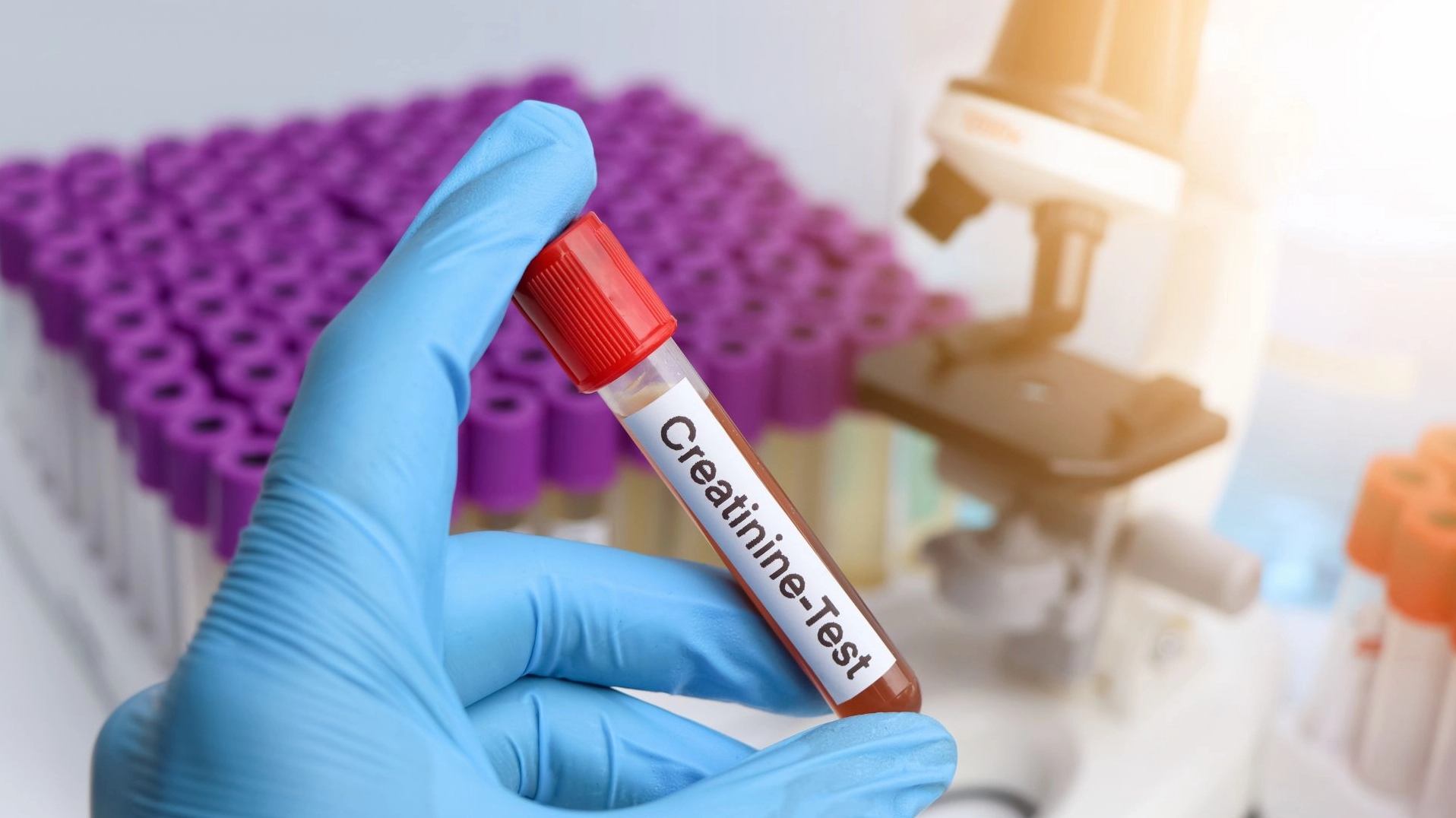 Giải đáp thắc mắc creatinin trong máu cao là bệnh gì và cách phòng ngừa