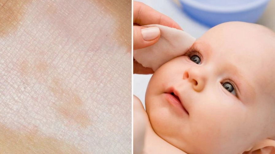 Giải đáp thắc mắc da bị loang trắng là bệnh gì theo góc nhìn y khoa