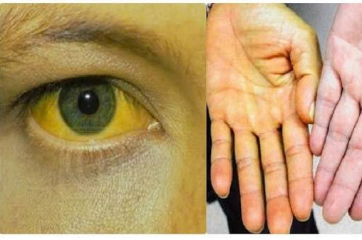 Giải đáp thắc mắc da vàng thì bị bệnh gì và cách nhận biết sớm