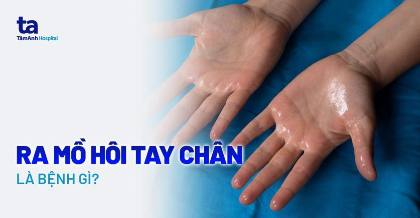 Giải đáp thắc mắc ra mồ hôi tay bị bệnh gì và cách xử lý hiệu quả