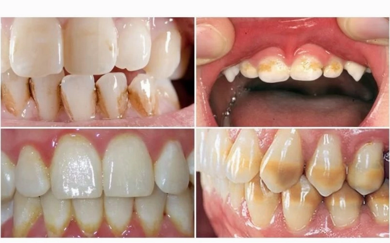 Giải đáp thắc mắc răng bị vàng là bệnh gì và cách khắc phục hiệu quả