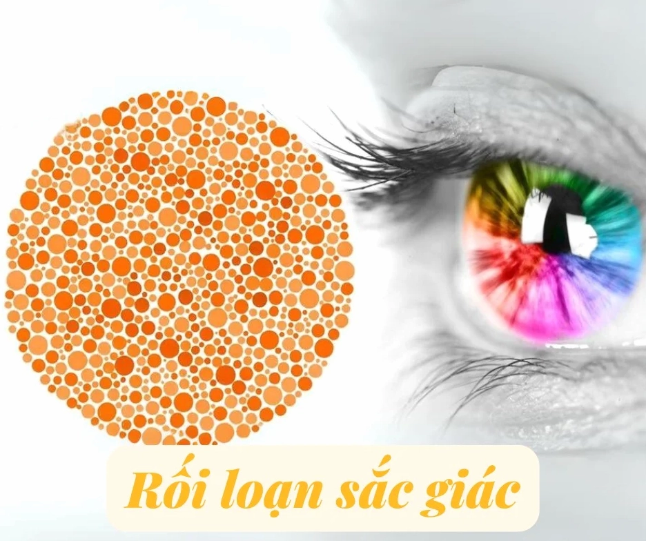 Giải đáp thắc mắc rối loạn sắc giác là bệnh gì cho người bệnh