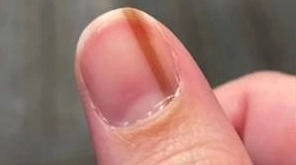 Giải đáp thắc mắc sọc nâu ở móng tay là bệnh gì bạn cần lưu ý