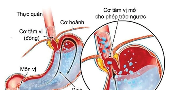 Giải đáp thắc mắc tức nghẹn ở ngực là bệnh gì và cách xử trí an toàn