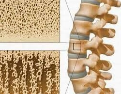 Giải đáp thiếu calci gây ra bệnh gì và dấu hiệu nhận biết sớm