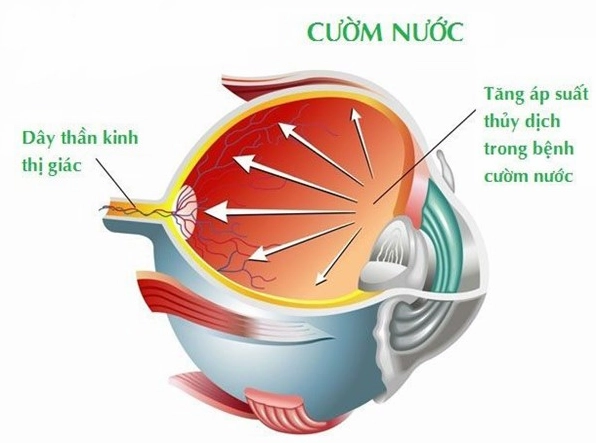 Giải đáp tường tận về glaucoma là bệnh gì cùng các thông tin cần biết