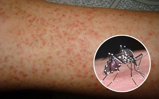 Giải đáp virus dengue gây ra bệnh gì và cách phòng tránh hiệu quả