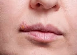 Giải mã bí ẩn cold sore là bệnh gì và cách xử lý khoa học