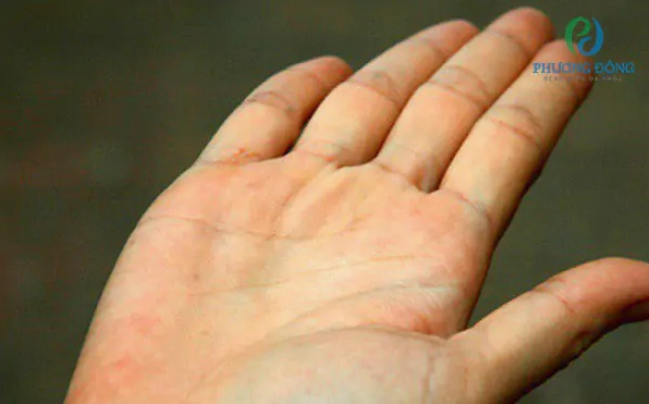 Giải mã hiện tượng lòng bàn chân màu vàng là bệnh gì và cách nhận diện