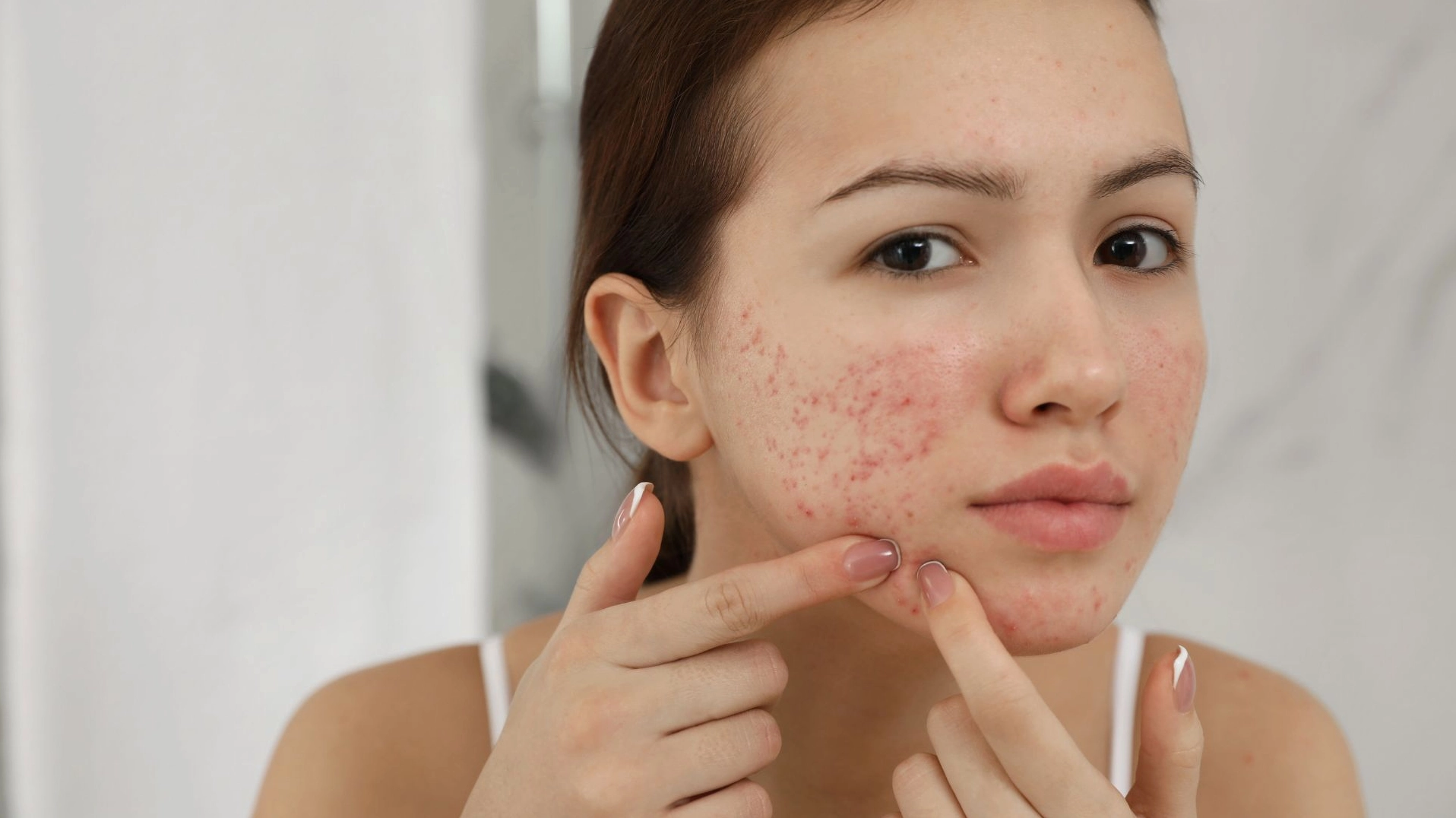 Giải mã kiến thức về bệnh gia liễu là gì và các lưu ý cần biết