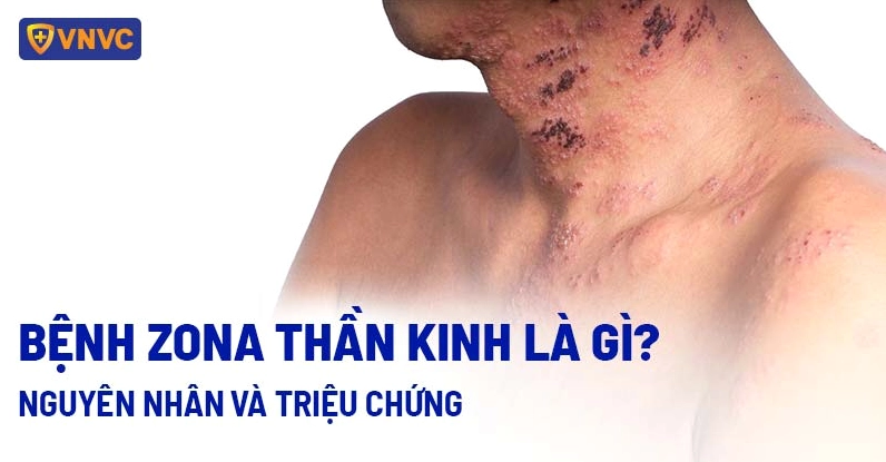 Giải mã shingles là bệnh gì và những kiến thức y khoa cần biết