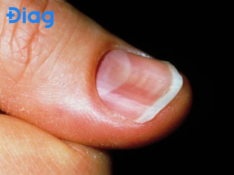 Giải mã tình trạng móng tay bị lõm ngang là bệnh gì cần biết