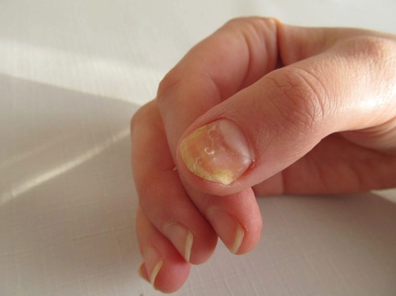 Giải mã tình trạng móng tay cái bị lõm là bệnh gì và cách điều trị