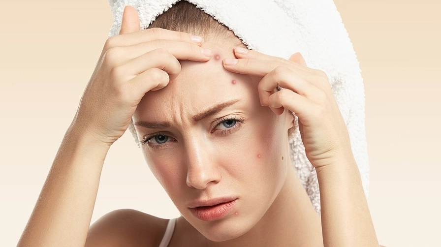 Giải mã tình trạng mụn mọc ở mặt là bệnh gì và cách nhận diện