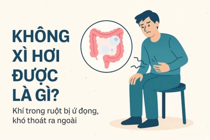 Giải thích tình trạng không xì hơi được là gì