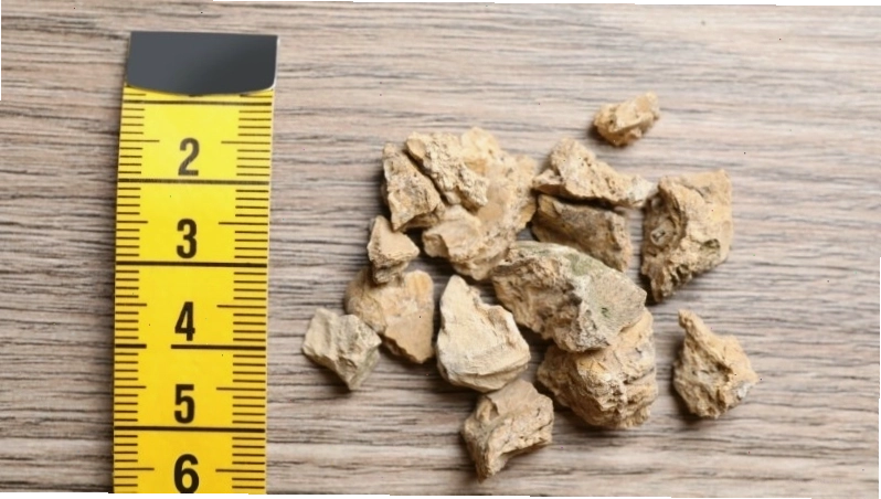 Giảm kích thước sỏi thận