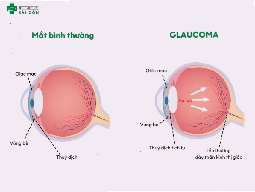 Glaucoma gây tổn thương thị giác nghiêm trọng