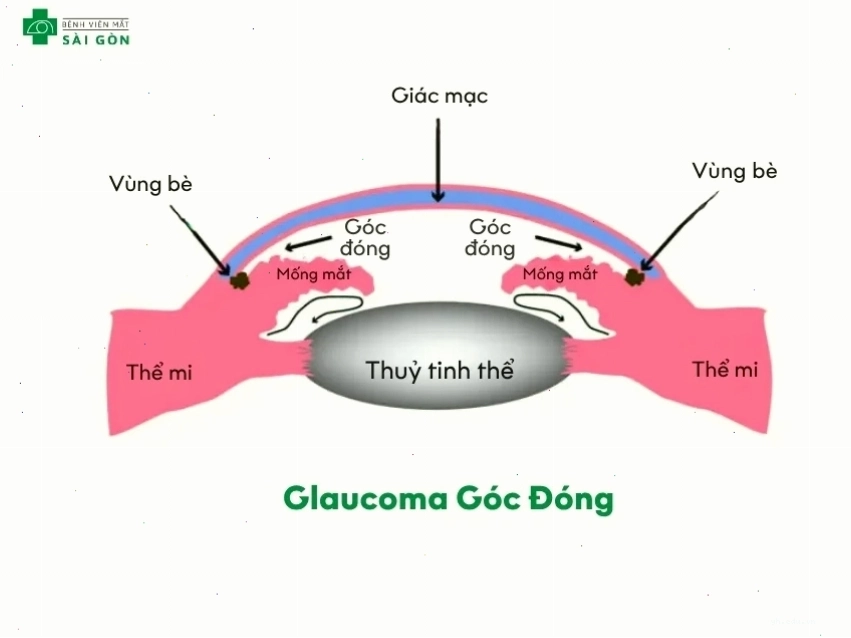 Glaucoma góc đóng làm mắt thị lực nhanh chóng
