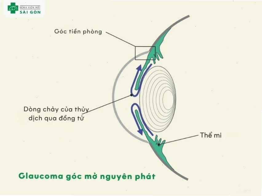 Glaucoma góc mở nguyên phát là dạng phổ biến nhất
