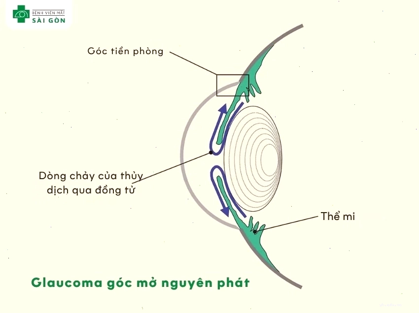 Glaucoma góc mở nguyên phát