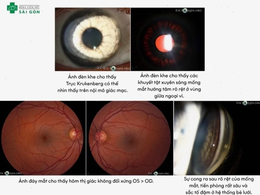 Glaucoma sắc tố thường ở người trẻ và cận thị