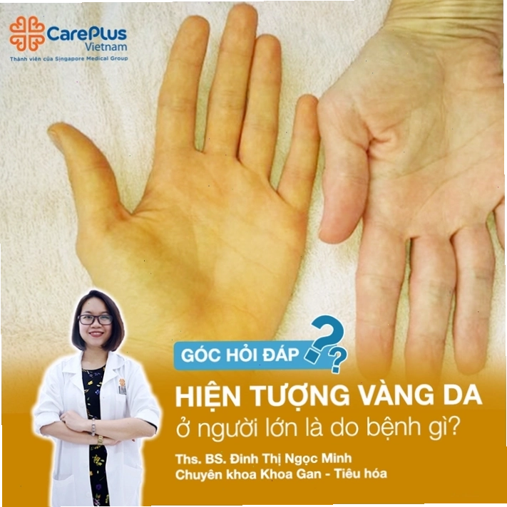 Góc giải đáp hiện tượng vàng da ở người lớn
