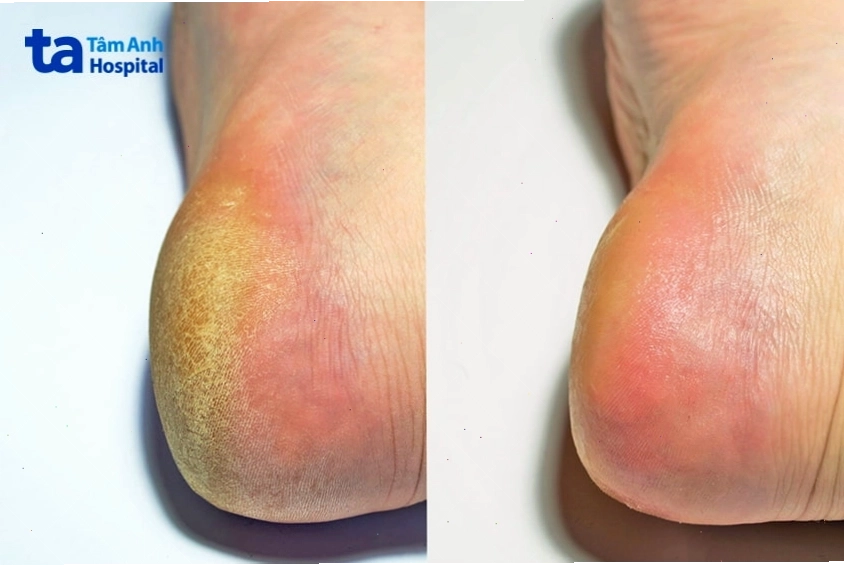 Gót chân bị chai sần trước và sau khi được điều trị cải thiện da