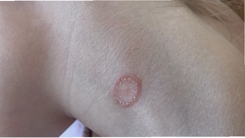 Hắc lào vùng cổ