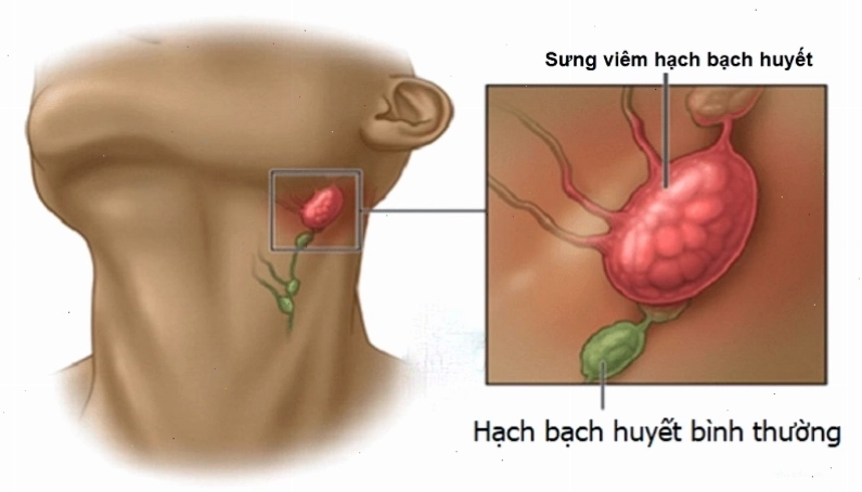 Hạch bạch huyết bị sưng viêm