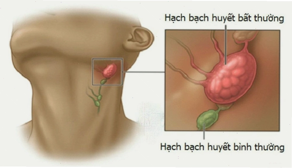 Hạch nông tập trung ở vùng cổ