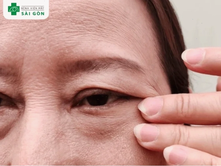 Hai dạng sụp mí mắt chính bao gồm bẩm sinh và mắc phải