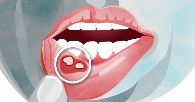 Hay bị nhiệt lưỡi là bệnh gì và những điều cần lưu ý để phòng ngừa