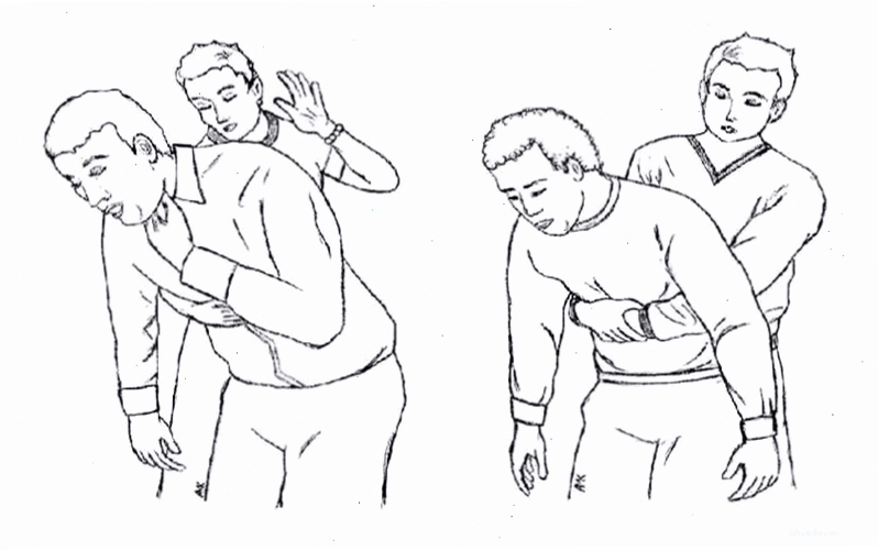 Heimlich là nghiệm pháp chữa nghẹn cho người già hiệu quả được khuyên áp dụng