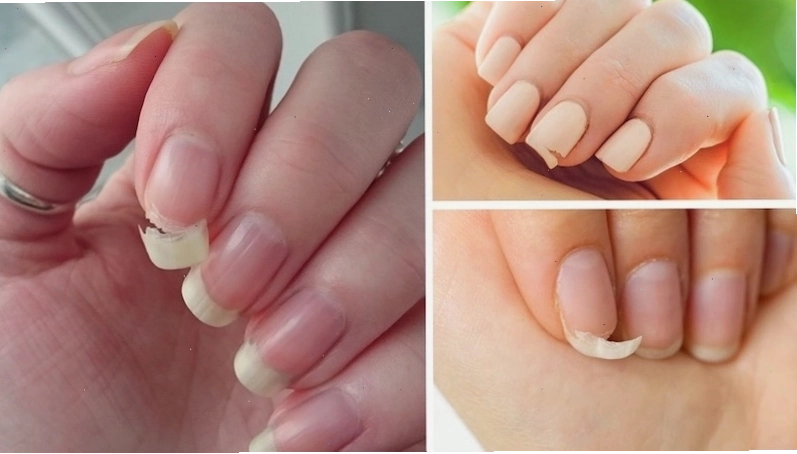Hiện tượng móng tay dễ bị gãy cảnh báo cơ thể có nhiều nguy cơ bị thiếu chất