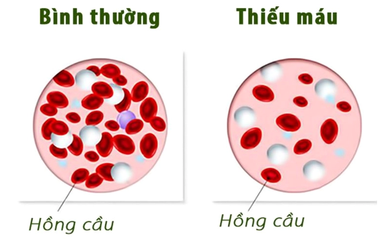 Hiểu đúng về anemia là bệnh gì và những kiến thức y khoa cần biết