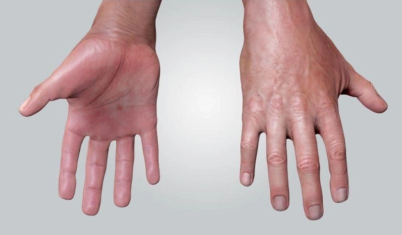 Hiểu đúng về bị bệnh phong thấp là gì và cách chăm sóc sức khỏe