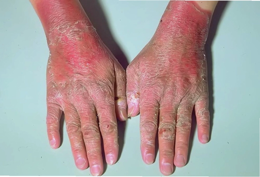 Hình ảnh bàn tay của người mắc bệnh pellagra với biểu hiện viêm da điển hình